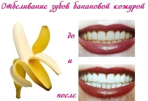 Отбеливание зубов банановой кожурой Отбеливание зубов банановой кожурой