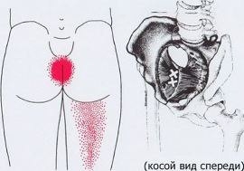 Карта точек боли в теле и точек натяжения мышц: таз, ягодицы и бедра