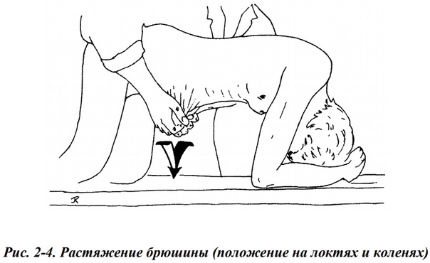 Техника растяжения брюшины Техника растяжения брюшины
