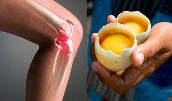 Как использовать 2 яйца для полного исчезновения боли в колени и «ремонта» суставов