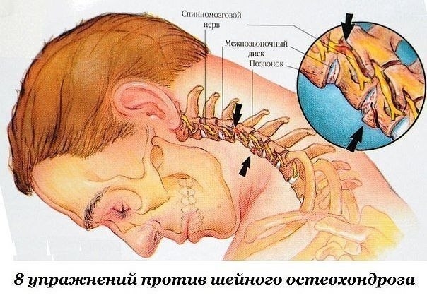 Первые проявления шейного остеохондроза — боли в спине, головные боли, головокружение, "мушки" в гла