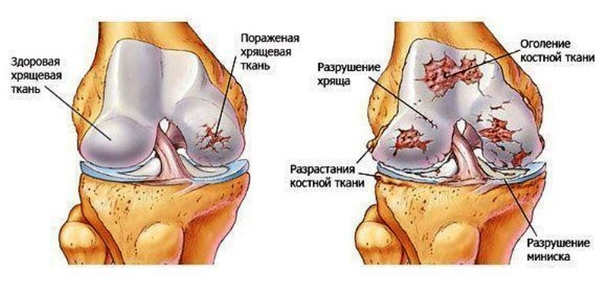 Чудо рецепт от боли в суставах!! Чудо рецепт от боли в суставах!!