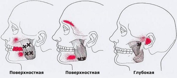 Карта точек боли в теле и точек напряжения мышц: Голова и шея