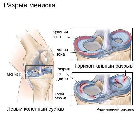 Мениски коленного сустава и их повреждения