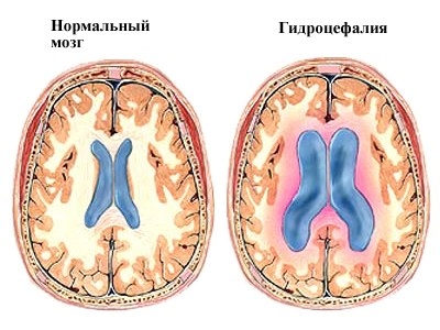 Гидроцефалия - заболевание, которое обычно характеризуется избыточным скоплением цереброспинальной (спинномозговой) жидкости в желудочковой системе головного мозга, в результате затруднения ее перемещения от места секреции – от желудочков головного мозга 