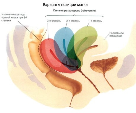 Ретрофлексия матки - возможная причина болезненных менструаций, аноргазмии, бесплодия. Ретрофлексия матки - возможная причина болезненных менструаций, аноргазмии, бесплодия.