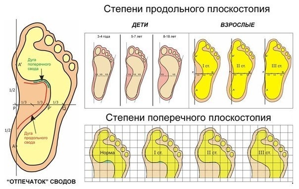 Разные факторы, в совокупности или по отдельности, приводят к существенным деформациям стопы, приносящим боль и дискомфорт при ходьбе.